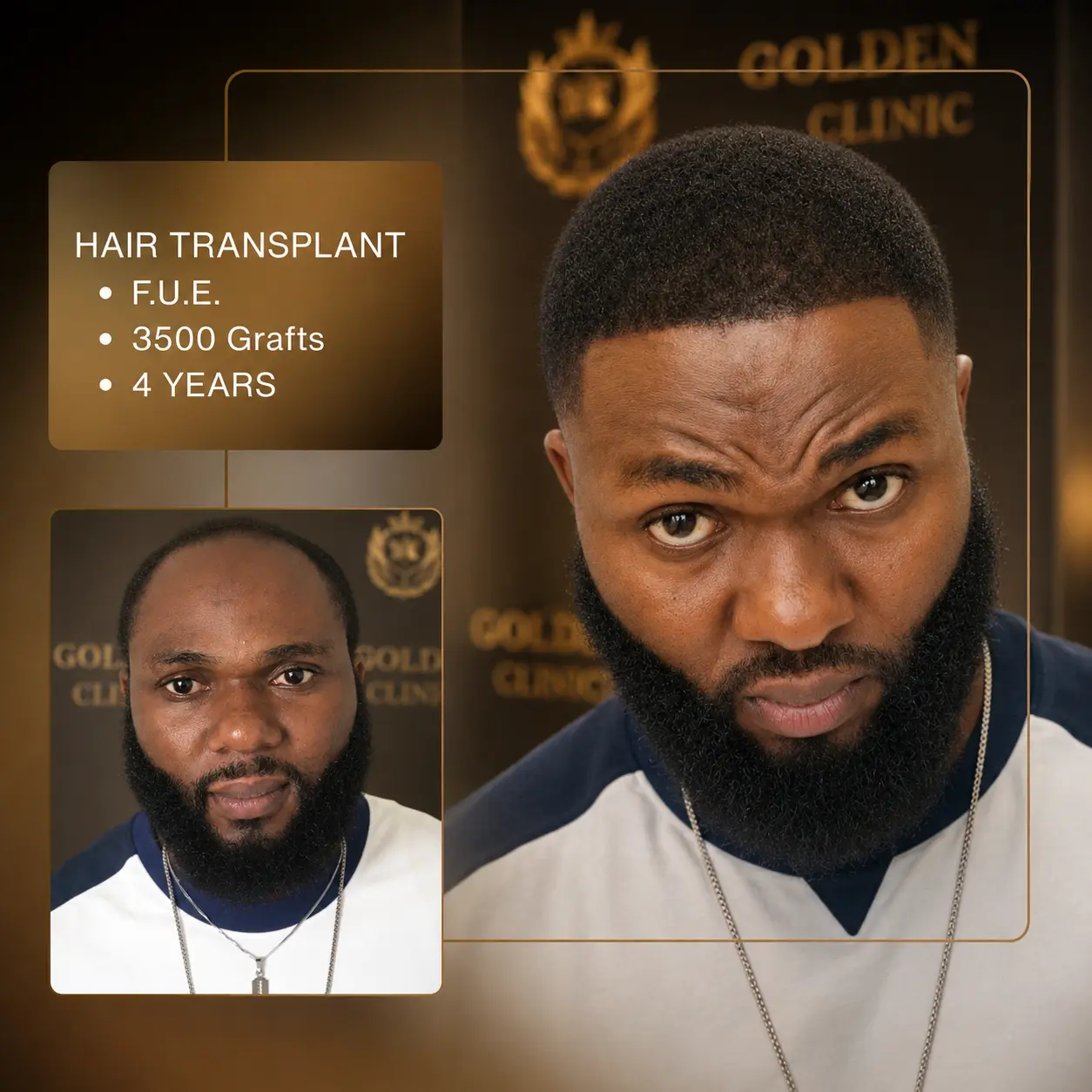 Before & After - D.H.I. 4,200 Grafts