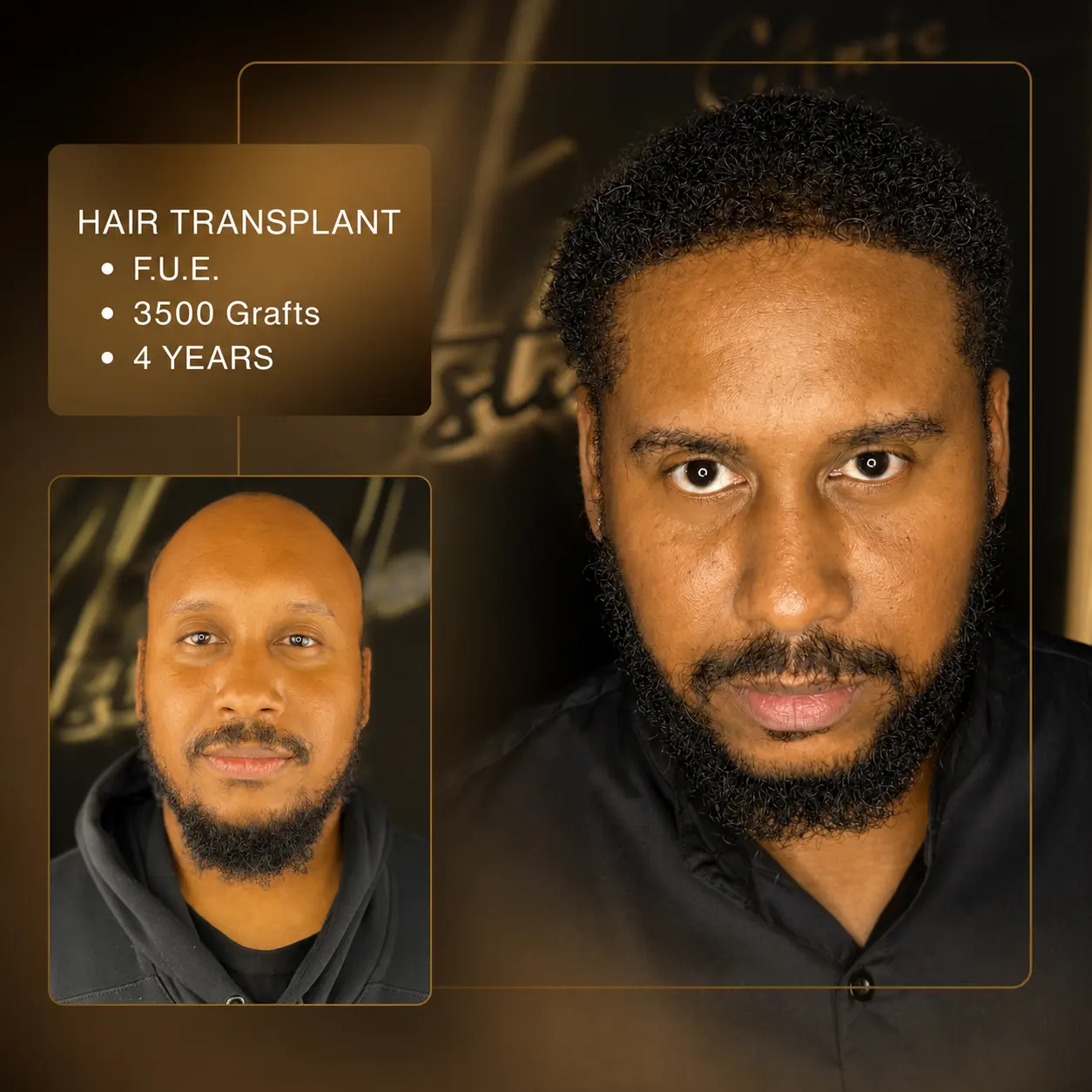 Before & After - F.U.E. 5,000 Grafts